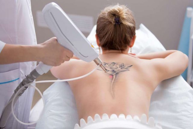 Mit einer Laserbehandlung können unerwünschte Tattoos entfernt werden. Das ist allerdings oft langwierig und schmerzhaft. Foto: djd/www.galenpharma.de/Adobe Stock/4frame group
